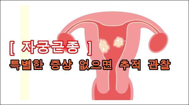 특별한 증상 없는 ‘자궁근종’은 추적관찰이 우선