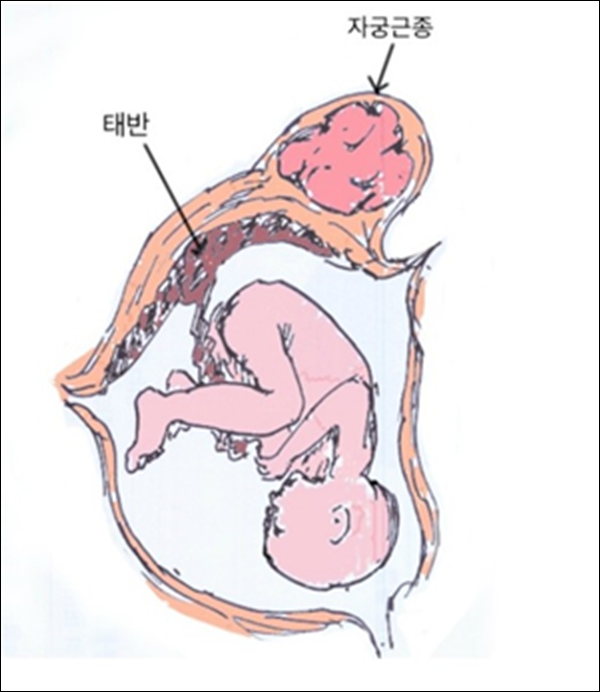 임신 중에 ‘자궁근종’이라면 어떻게 치료해야 하나요?